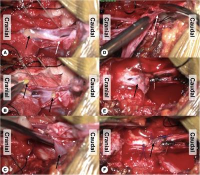 Sacral terminal filar cyst: a distinct variant of spinal meningeal cyst and midterm clinical outcome following combination resection surgery